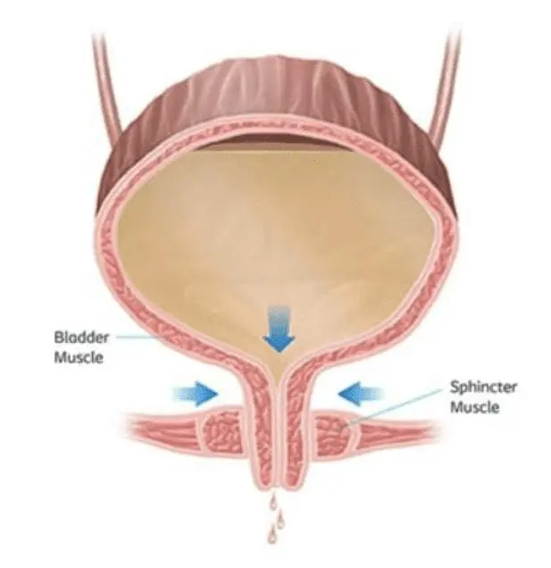 Stress Urinary Incontinence