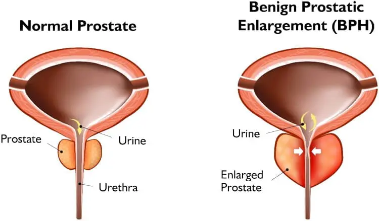 Urolift for BPH