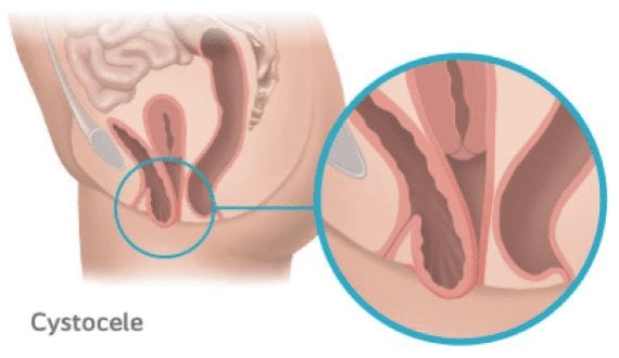 Cystocele